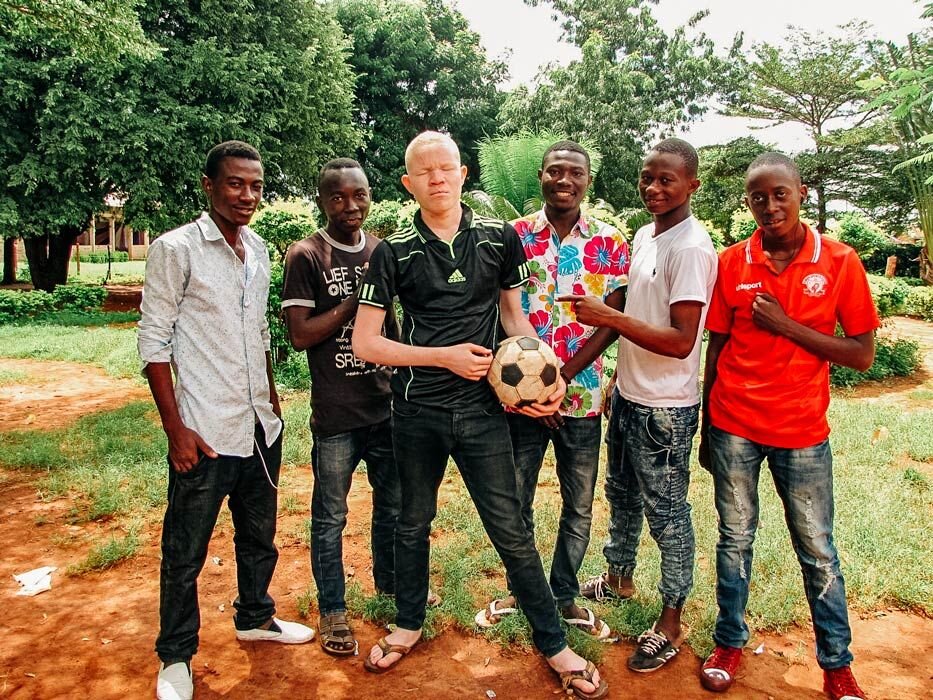 What is Albinism? Five Things You Should Know