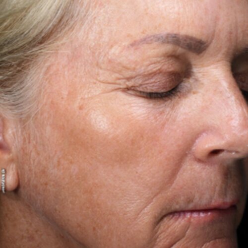 Laser Facial First Time Offer