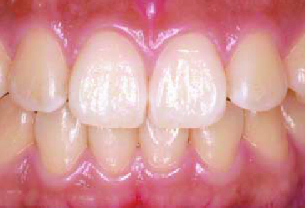 Front view of teeth