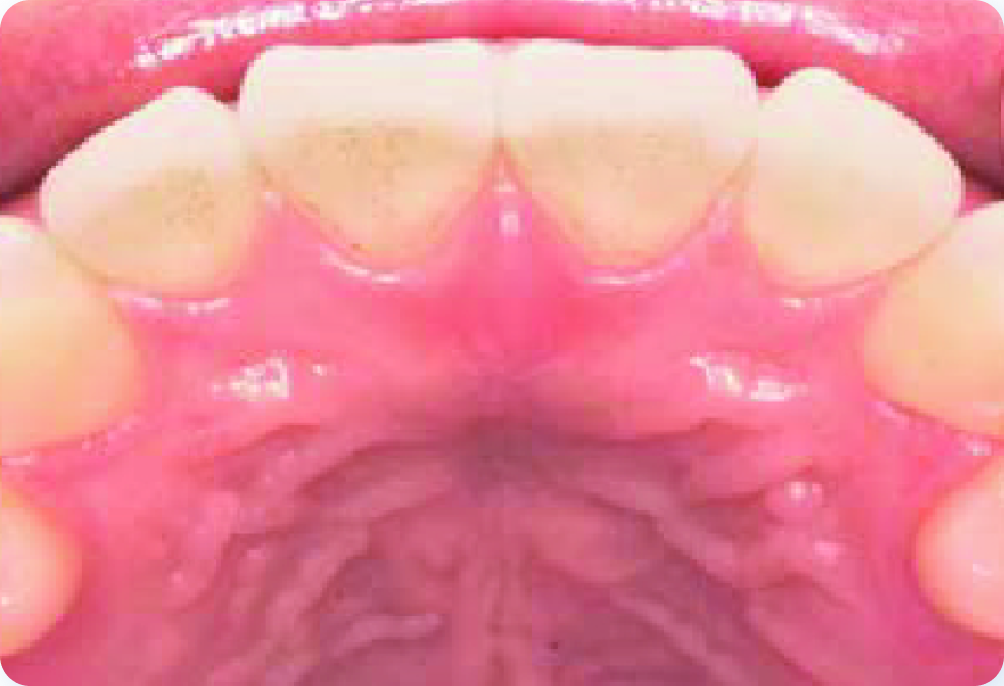 Upper jaw view of teeth