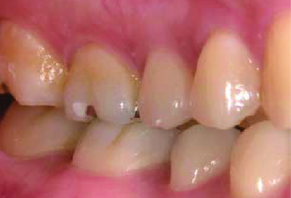Right side view of teeth