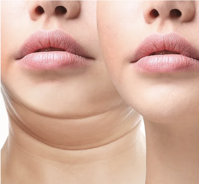 Illustration of fat removal
