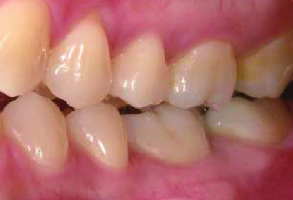 Left side view of teeth