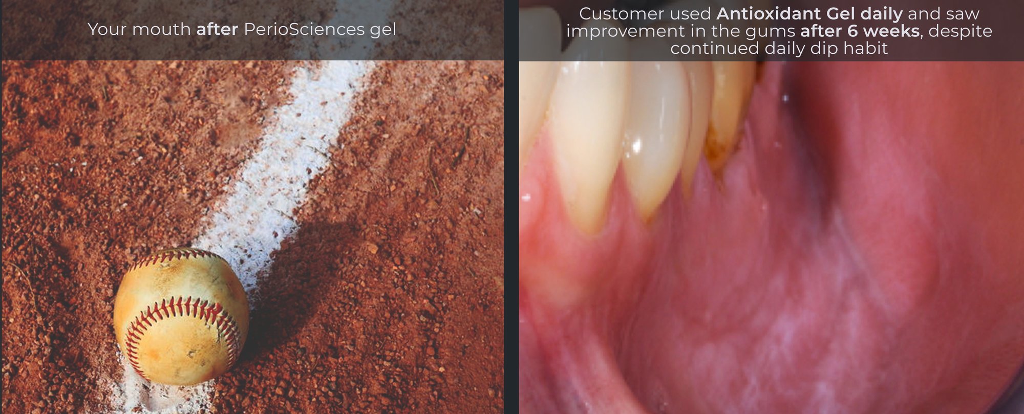 Say BALL GAME To Dip Lip – PerioSciences